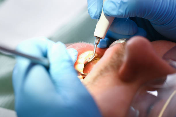 Best Emergency Root Canal Treatment in Charleston, IL