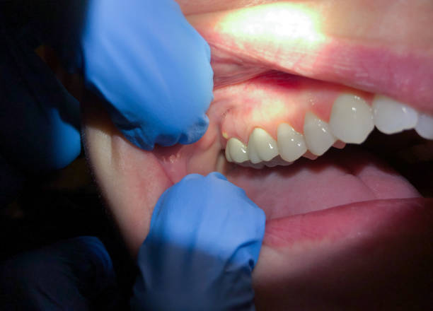 Best Emergency Root Canal Treatment in Charleston, IL