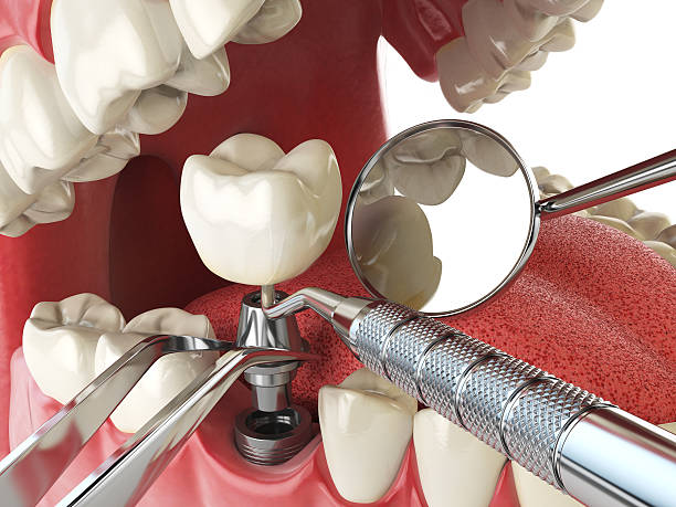 Best Emergency Dental Extractions in Charleston, IL