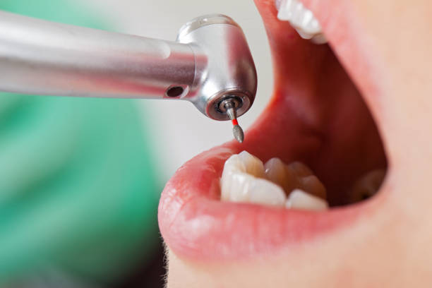 Best Emergency Dental Extractions in Charleston, IL